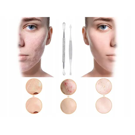 Zestaw łyżeczek do usuwania wągrów zaskórników 01751